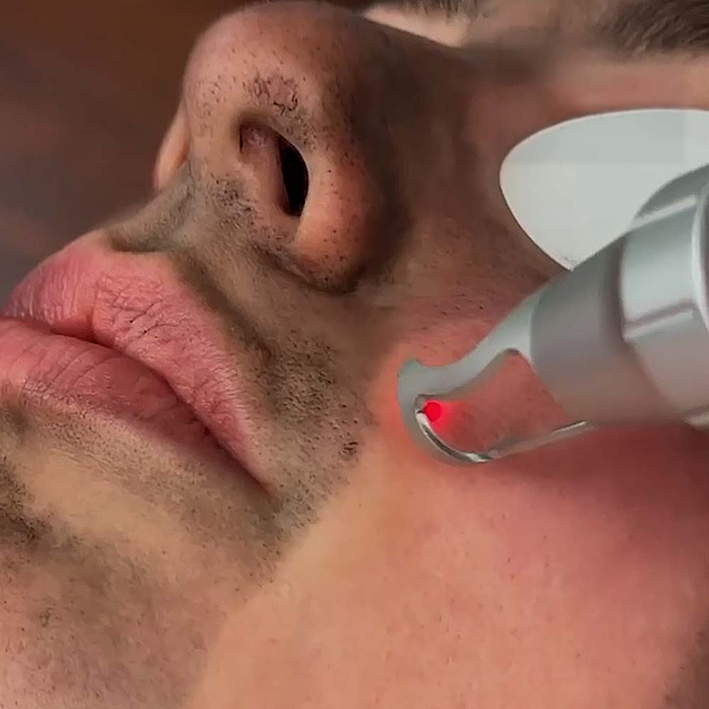 Carbon Facial Laser Exfoliation