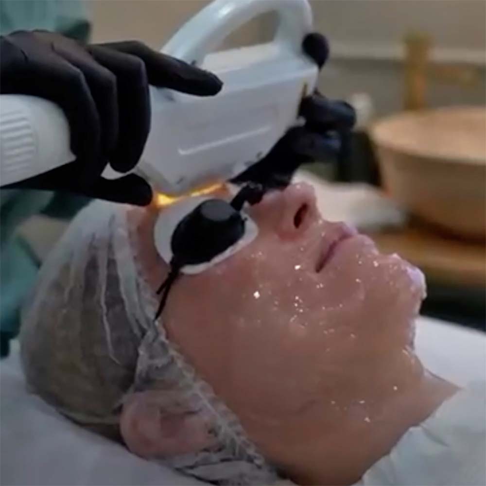 IPL Skin Rejuvenation - Light Pulses
