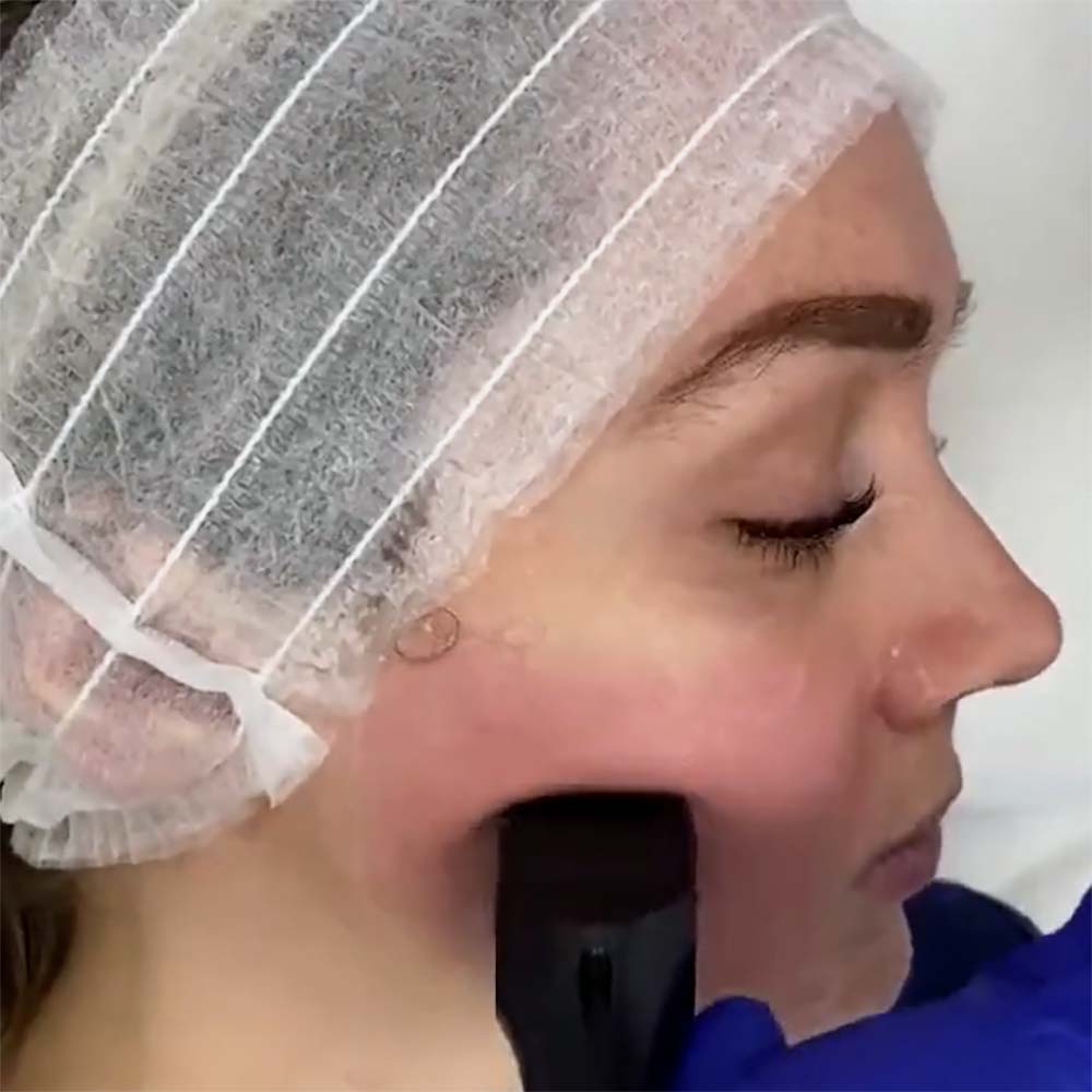 Radio Frequency (RF) Skin RF Tightening - Targeted Delivery