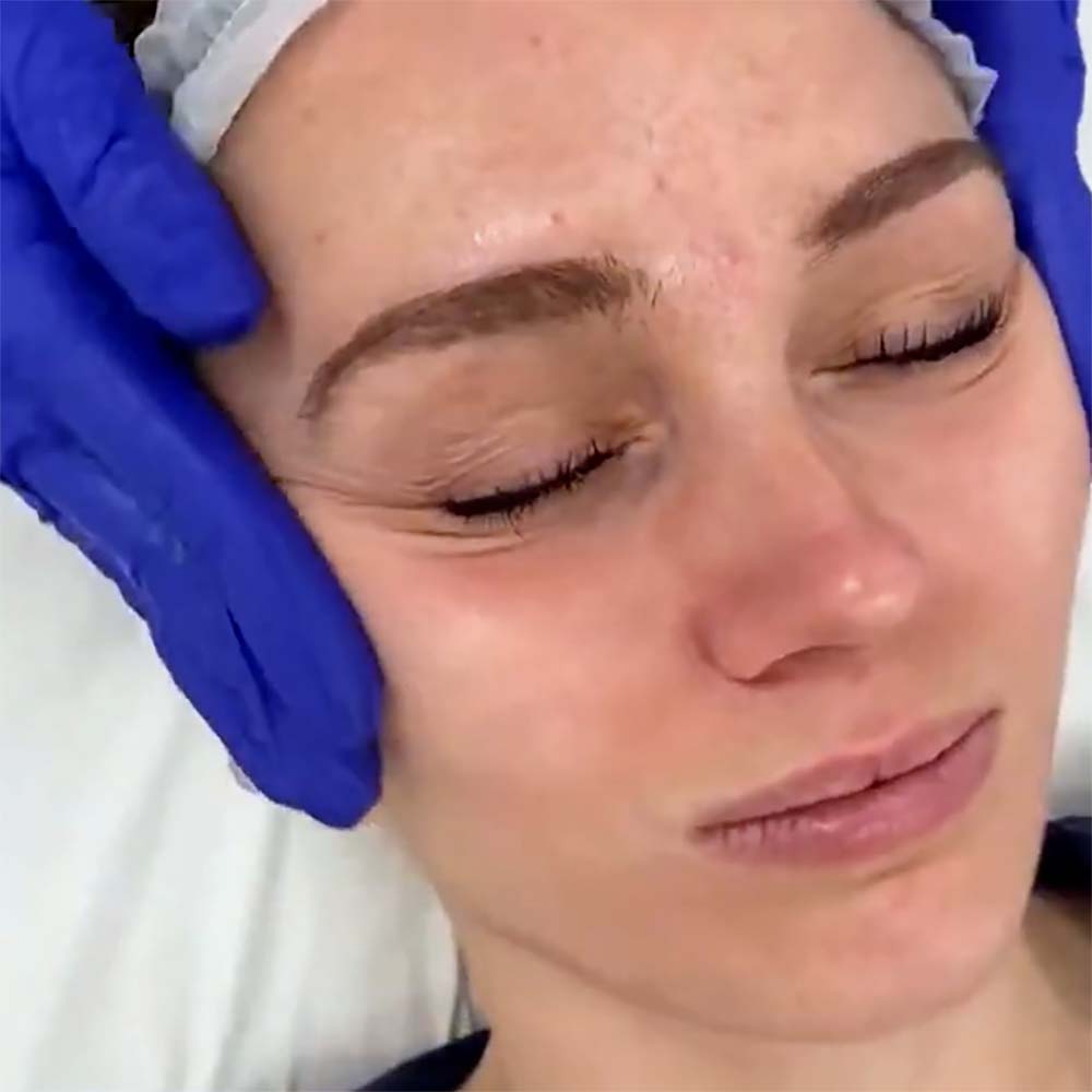 Radio Frequency (RF) Skin Tightening - After Glow